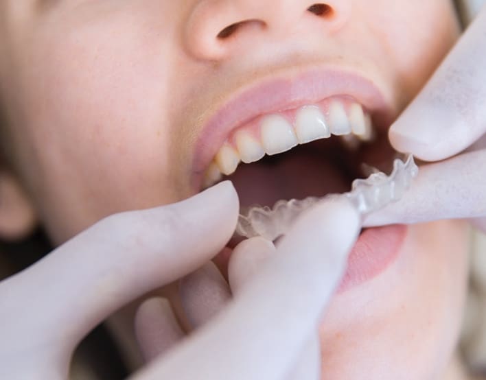 putting in retainer