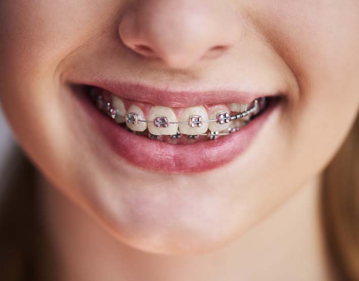 Braces for Kids in Davie