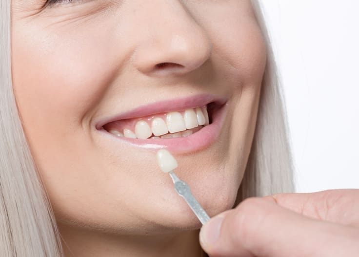 teeth whitening