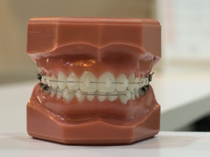 ceramic braces