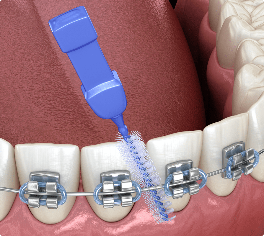 Cleaning braces