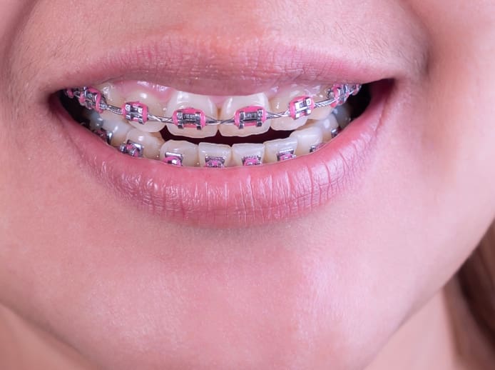 close up of braces