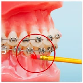 Poking wire - orthodontic emergency. on Vimeo