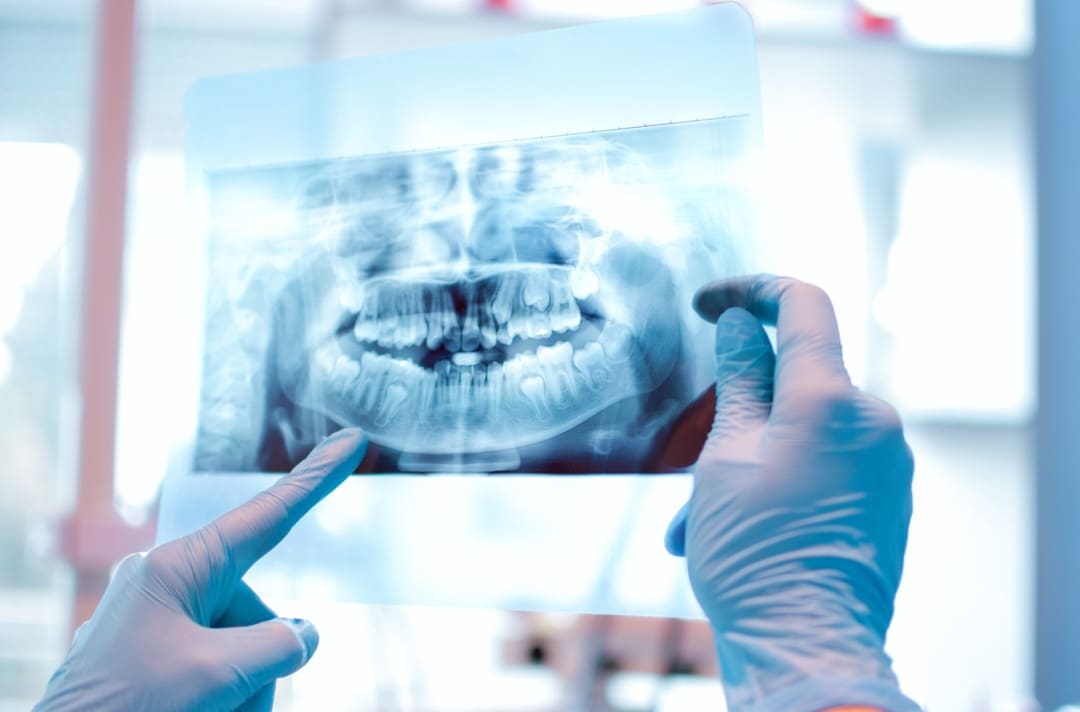 Xrays
